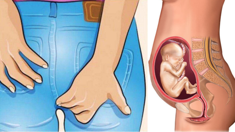 Emorroidi in gravidanza, 3 sintomi per riconoscerle e cosa fare per ridurre il dolore