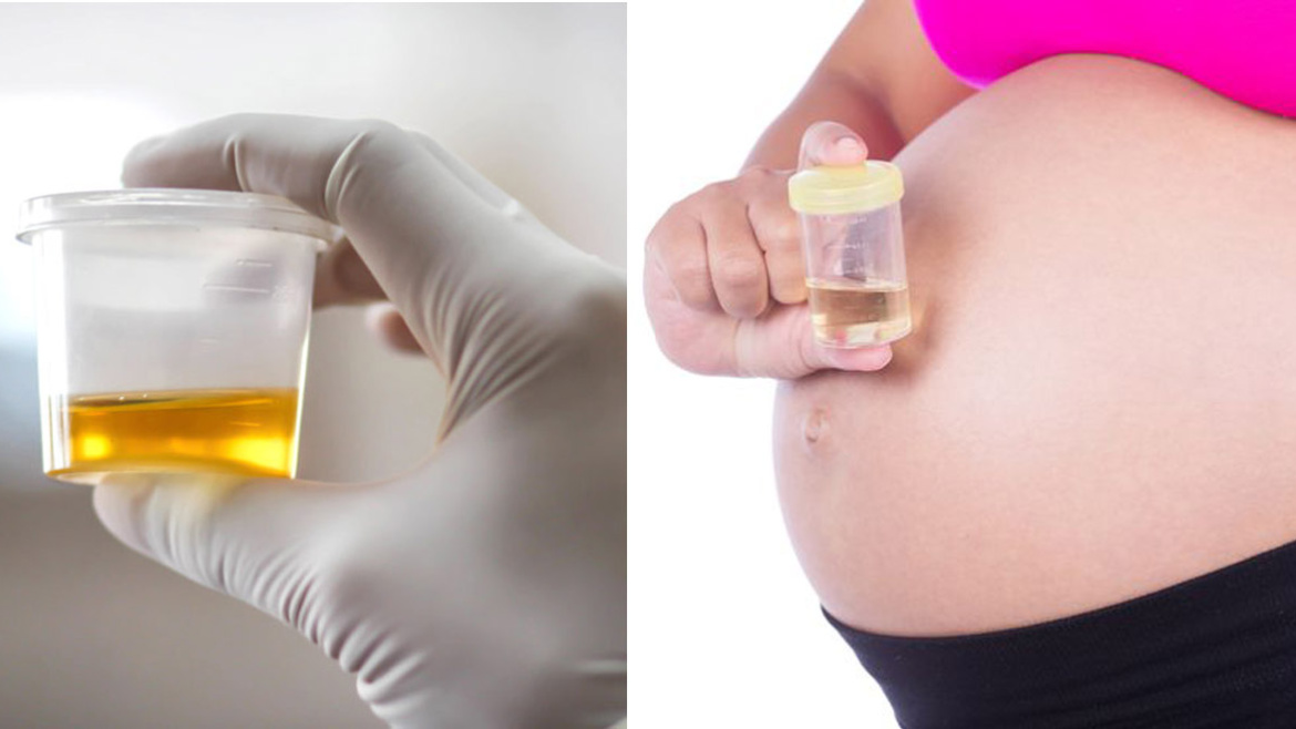 Glucosio nelle urine in gravidanza, quali sono i valori da non superare e cosa può succedere?
