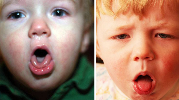 5 trucchi utili per calmare la tosse nei bambini e liberare il naso dal muco