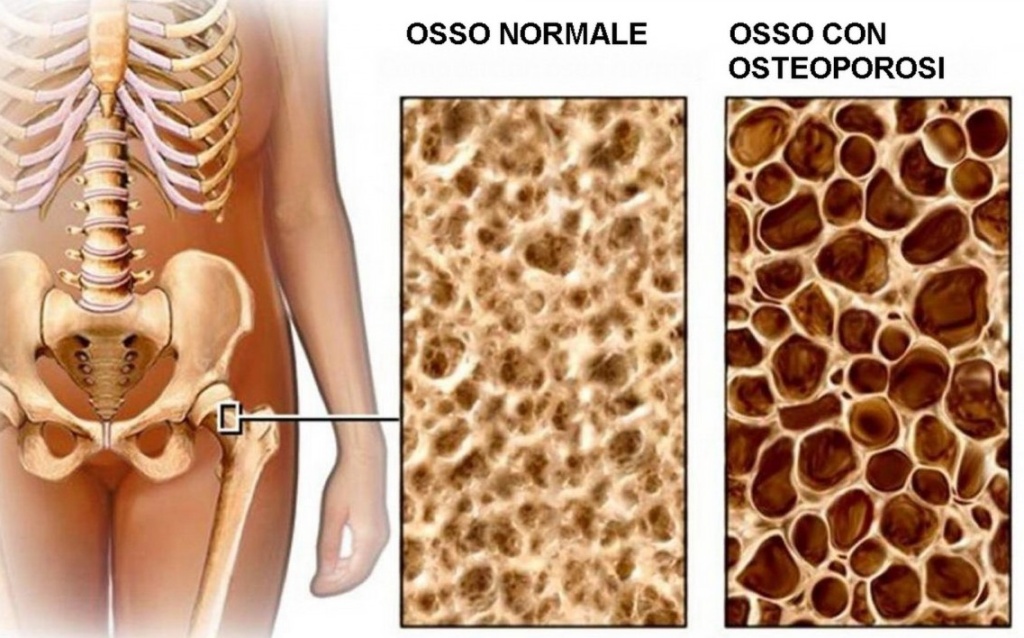 Osteoporosi