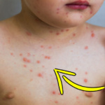 Puntini rossi sulla pelle di tuo figlio: cosa sono e come alleviare i sintomi?