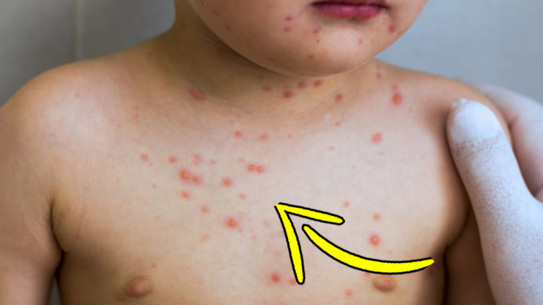 Puntini rossi sulla pelle di tuo figlio: cosa sono e come alleviare i sintomi?